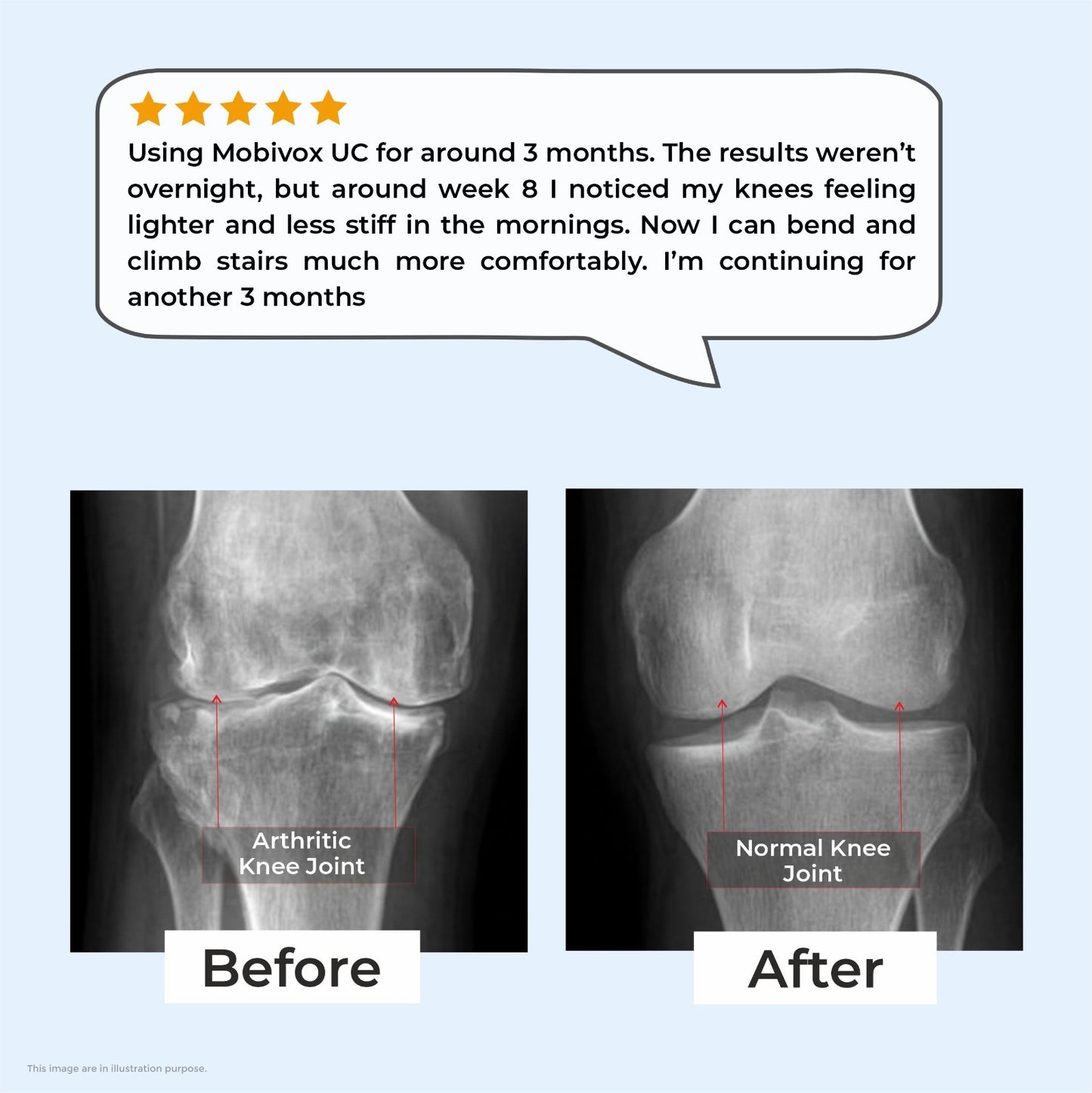 Mobivox UC – Reduce Knee & Joint Pain in Just 12 Weeks